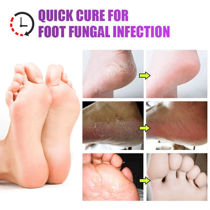 Foot Beriberi Treatment Cream for Foot Odor Tinea Pedis Anti-Itch Inhibits Fungus Athlete Foot Care Medical Ointment Cream